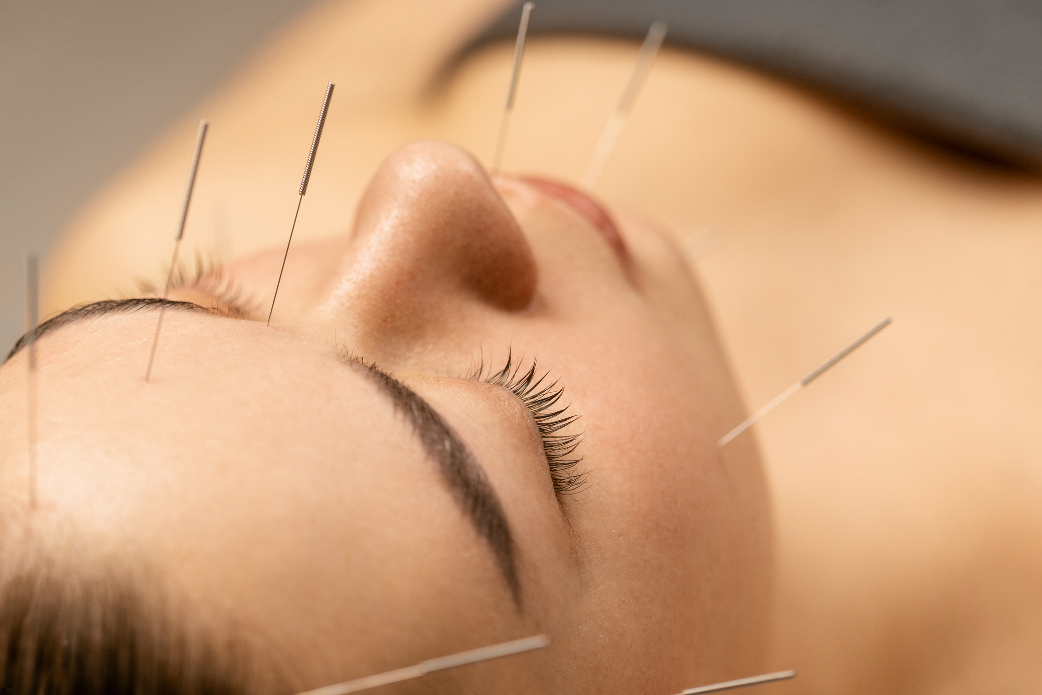 acupunctuurpunt rimpels